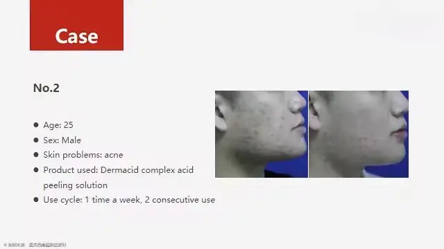 High Quality OEM Professional Beauty Salon Used 35% Anti Acne Aging Spots Mandelic Acid Salicylic Acid Chemical Peeling Gel