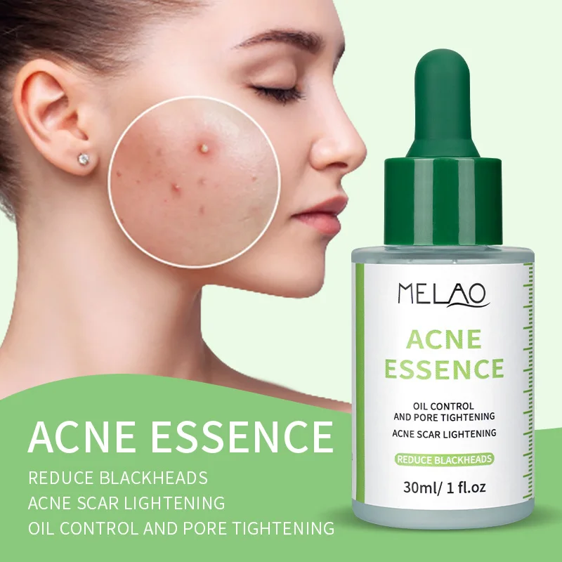 skin care acne treatment Natural Organic acne serum for acne remover scar lightening reduce blackheads