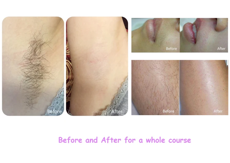 before and after 7502