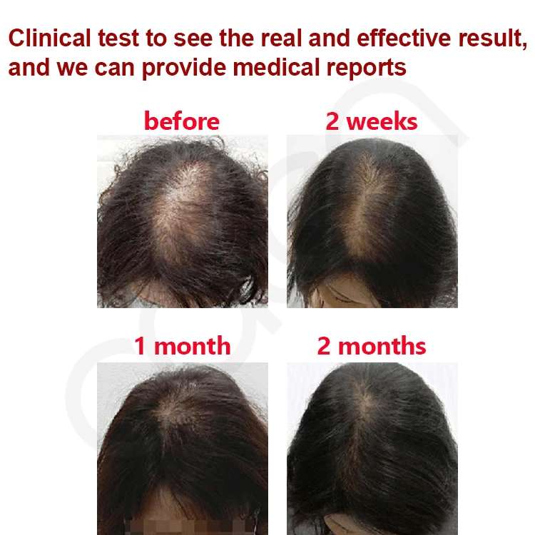 Oalen Hair Care Promote Hair Growth Massage Nourishing Saver Relieve Scalp Tension Refreshing Mint Scalp Oil