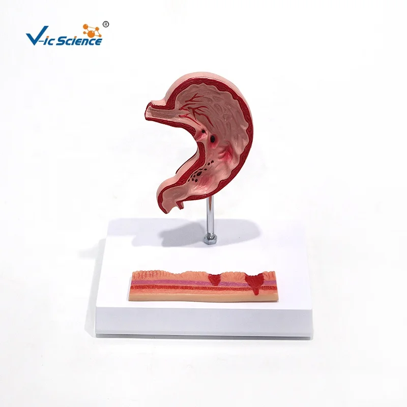 medical anatomical model Hot quality BN Plastic Stomach diseased  Gastric ulcer  anatomy model medical science education model