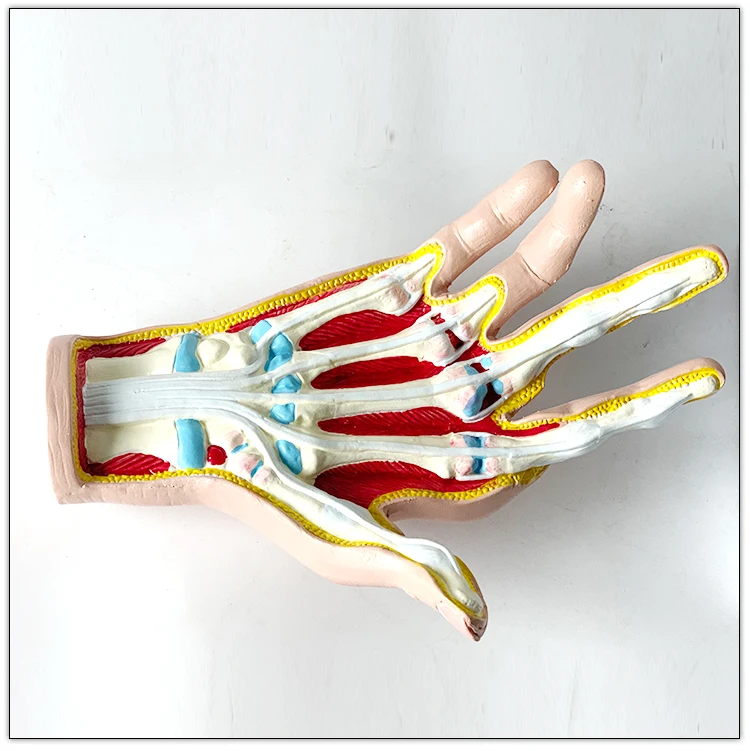 Anatomical model of human hand joint   Arthritis    Rheumatic fever
