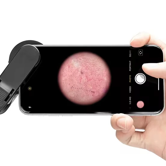 IBOOLO DE-300 home and Clinical Instrument for Pigmented Diseases medical dermatoscope dermoscope