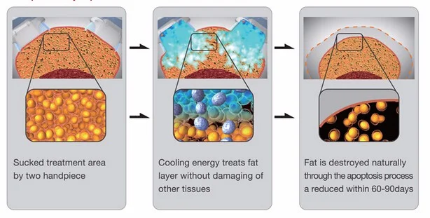 360 Cold Cellulite Cryotherapy Lose Weight Slimming Machine 360 Cryolipolysis  Device