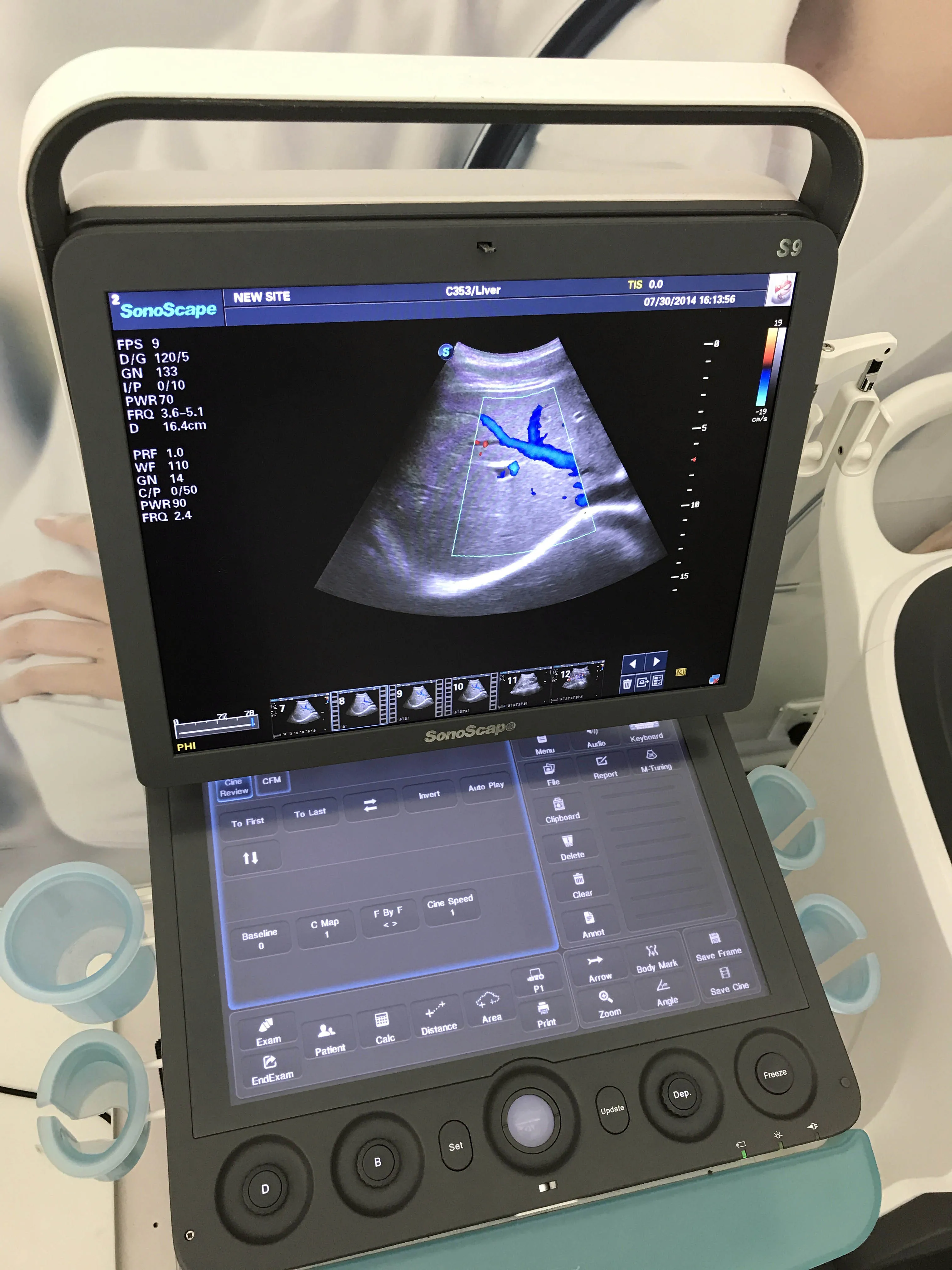 Лидер продаж медицинский ультразвуковой сканер высокого качества Цветной Допплер SonoScape E2 портативный цветной допплер