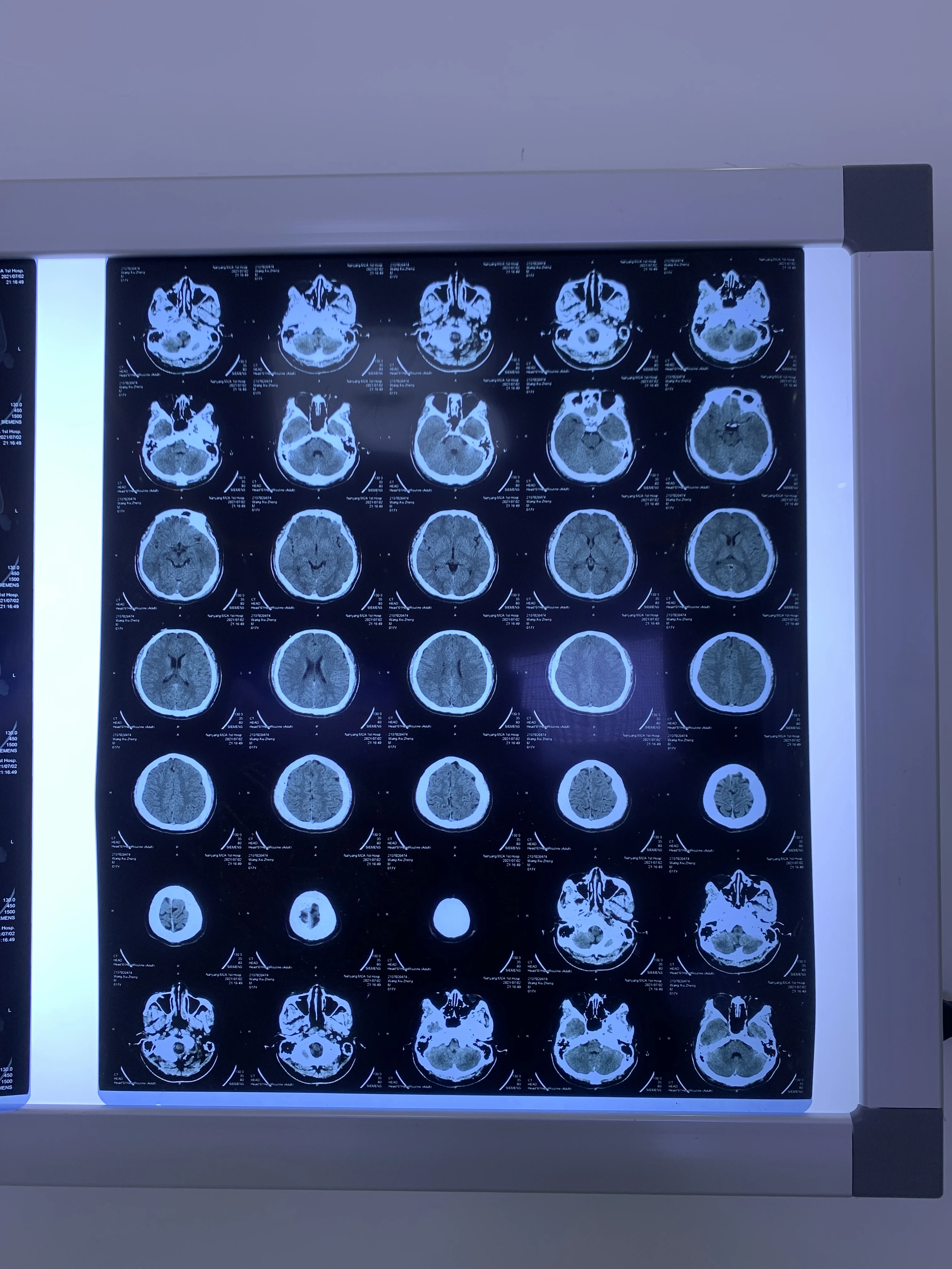 Blue Inkjet Medical Dry Film CT DR MRI X Ray Blue Transparent Film