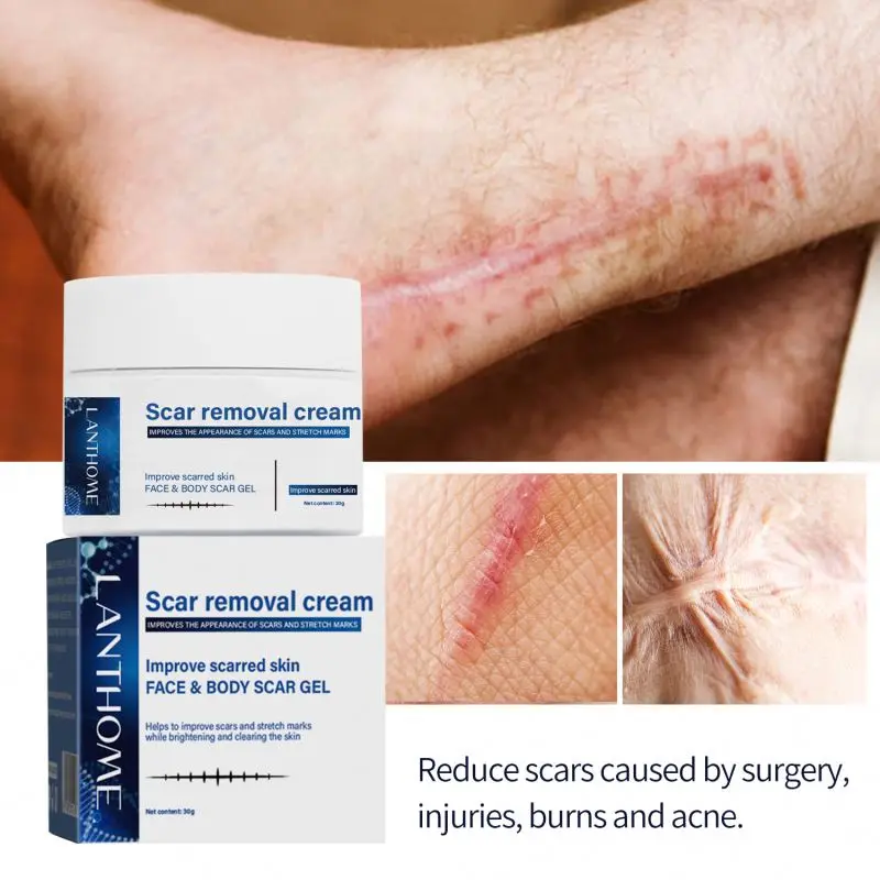 30g Old And Dark Spot On Leg Removal Cream Remove Postoperative Effectively Prevents Scar Proliferation After Surgery