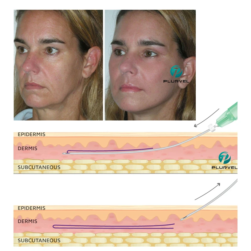 CE Korea PDO thread face lift thread tornado cog 3d 4d 6d pdo thread for medical skin tightening