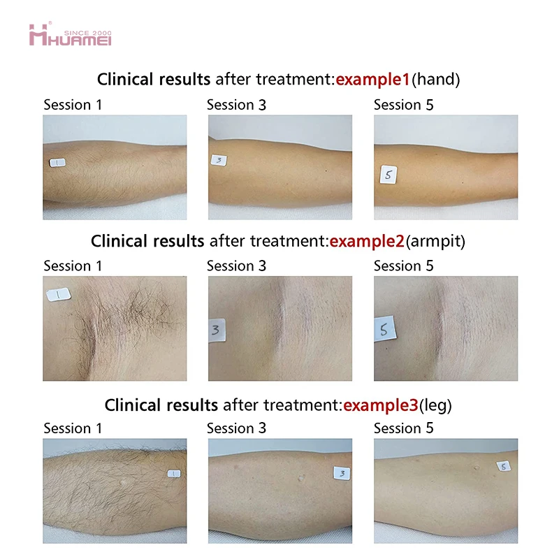 diode ice xl platinum 755 808 1064nm hair removal 808nm diode laser hair removal machine price