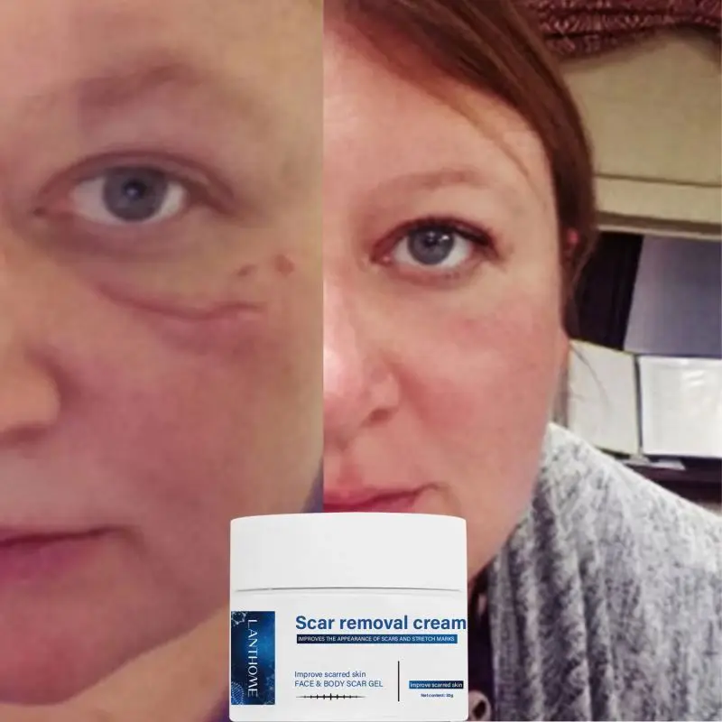 Surgery 30g Old And Dark Spot On Leg Removal Cream Remove Postoperative Effectively Prevents Scar Proliferation After Surgery
