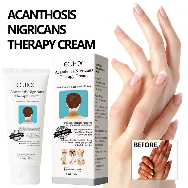 EELHOE 50g acanthosis nigricans therapy cream nape elbow knees knuckles back moisturizing brightening exfoliating cream