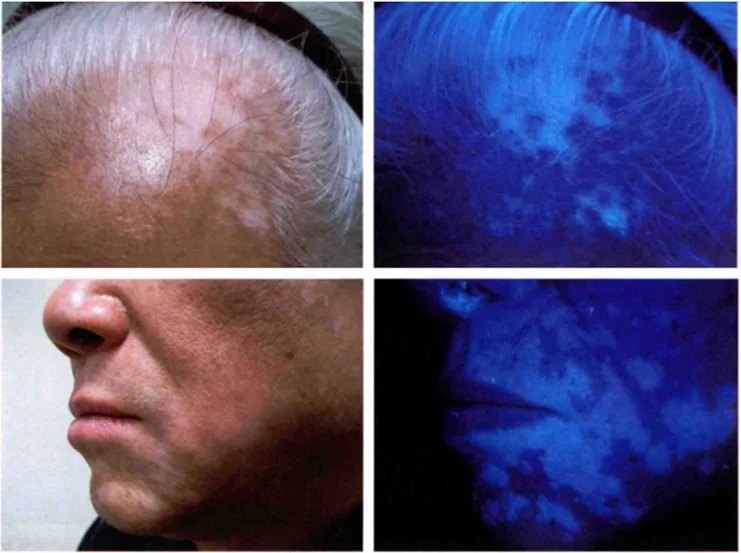 KN- 9000C 2020 new Medical woods lamp for dermatoscope skin analyzer Medical Woods Lamp for skin disease tester