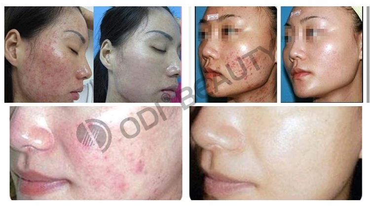 7 Colors PDT LED Light Therapy Jetpeel  Vertical Machine Beauty Skin Care