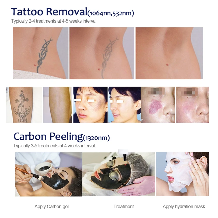 Q-swiched nd yag laser Professional nd yag laser tattoo removal machine with good price  AL-1