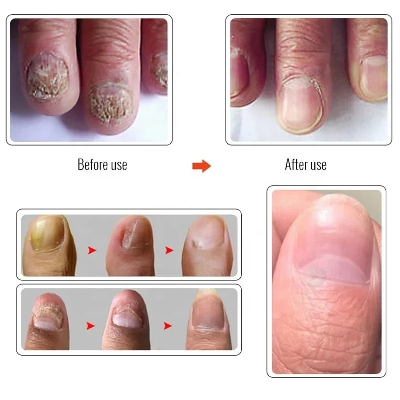 Customized Nail Fungus Oil Beautiful Healthy Nail Care Nail Fungal Treatment Serum for Hand Foot Removal Repair Gel