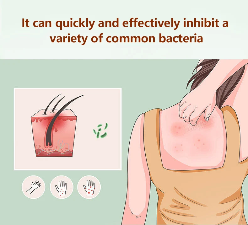 Anti-itching cream Provides Relief from Itching and Swelling for Mosquito Bites Insect Sting