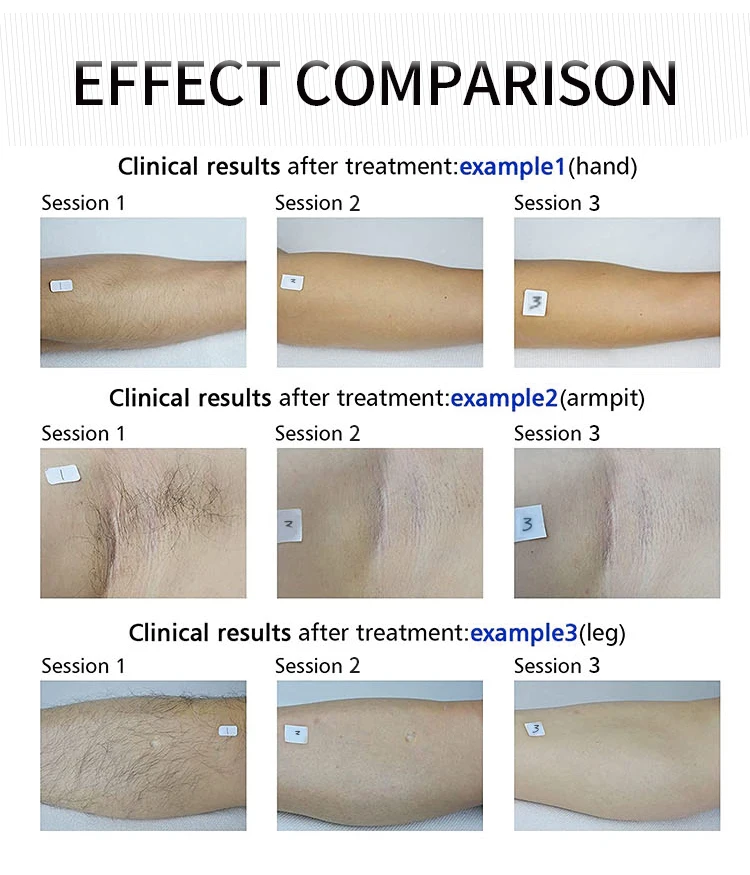 Hot Selling Customized Painless diode laser depilacion 808 nm hair laser depilator beauty 808 diode laser hair removal machine