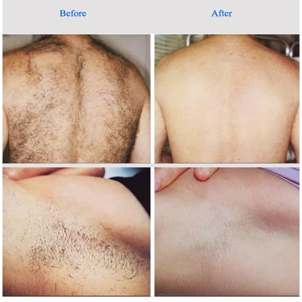 Hot Selling Ice Laser  12 Diode Laser Hair Removal 755nm 808nm 940nm 1064nm Medical Equipment