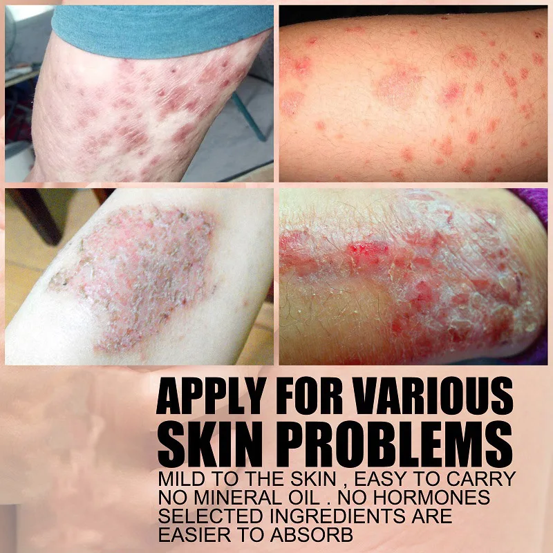 Magical Skin Cream Dermatitis and Eczema Skin Care Cream Antibacterial and Soothing Itching Cream for Tinea pedis Skin