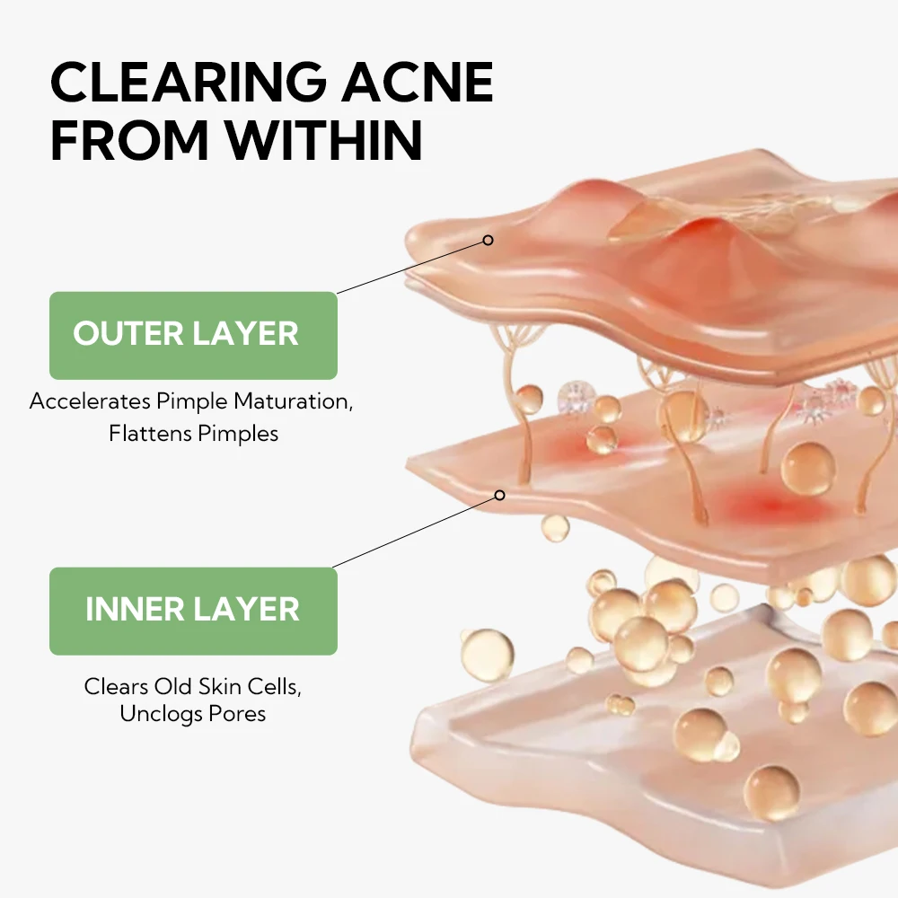 LANBENA Skin anti acne serum with 5% Niacinamide + 2% Salicylic Acid for Skin Repairing clears with 20pcs Cotton swab