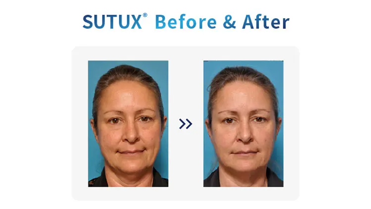 Cannula/micro Cannula/blunt Cannula