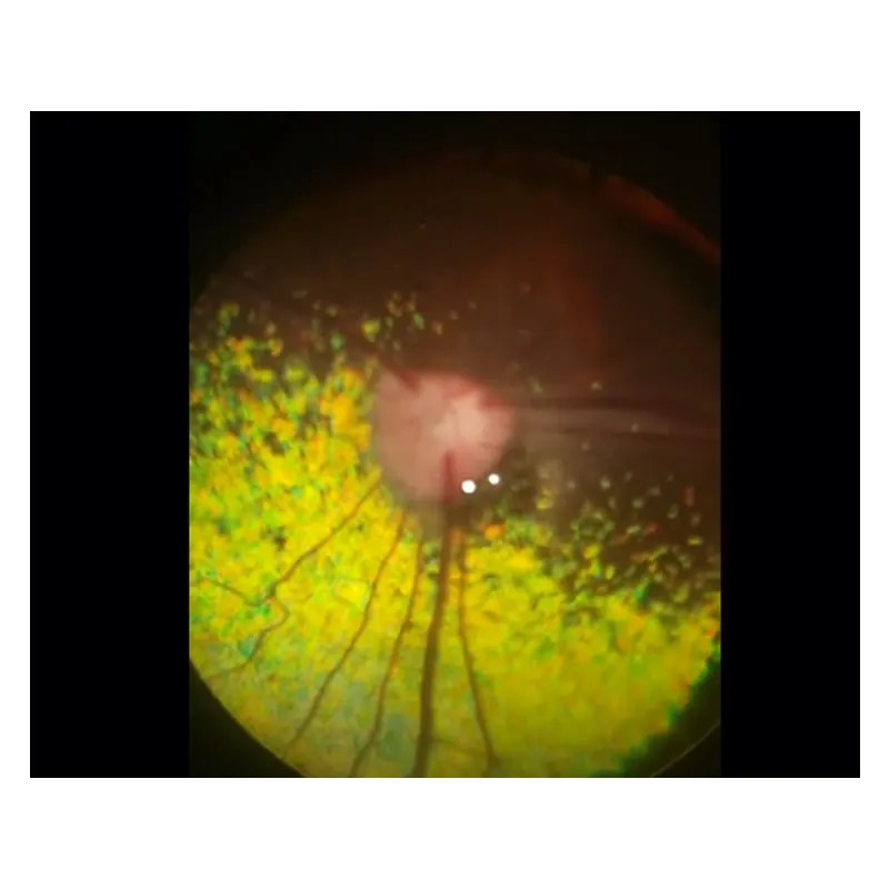 Portable Non-mydriatic fundus camera for ophthalmology, Non-mydriatic for fundus camera portable type