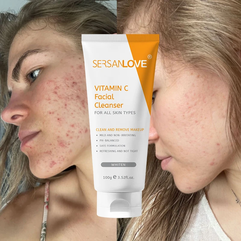 SERSANLOVE Hot Sale Acne Foaming Wash Deep Cleaning Shrink Pores Anti Acne Facial Cleanser For Oily Skin