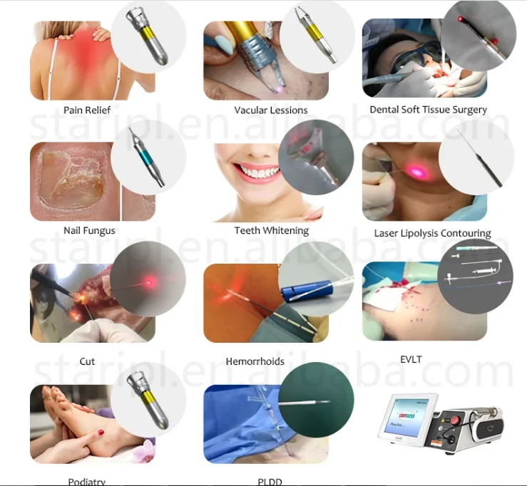 Hemorrhoids laser Fistula Prostate treatment 1470nm diode laser equipment Urology laser fistula rectal proctology Anorectal