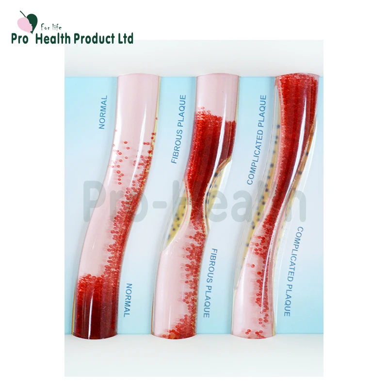 Dynamic vascular Blood Vessel Educational Teaching Model, LDL Low-density Lipoprotein Vascular Disease Model