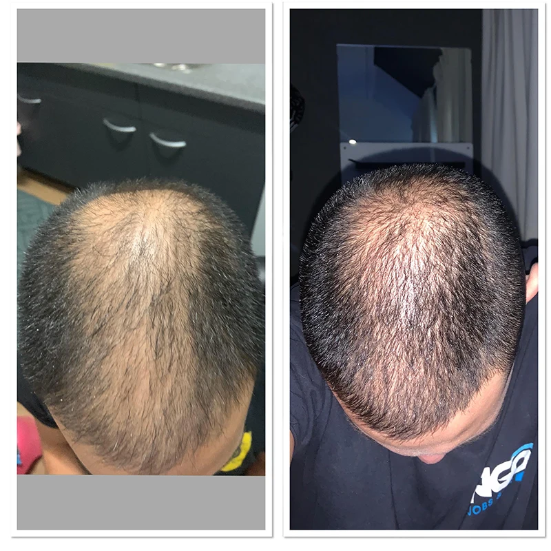 
0.25MM 128 NEEDLES MICRONEEDLE DERMA ROLLER Unwanted Acne Scars and Uneven Skin Texture 