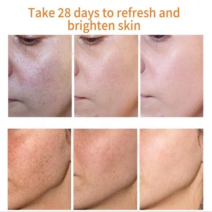 Pimples Melasma Blemish Removal Dark Spot Remover Cream Strong Bleaching Whitening Face Freckles Remove Corrector Cream