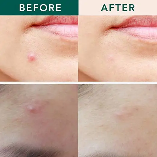 Discount Hydrocolliod Acne Patch Flower Heart Star Invisible Acne Patch Skin Care Acne Pimple