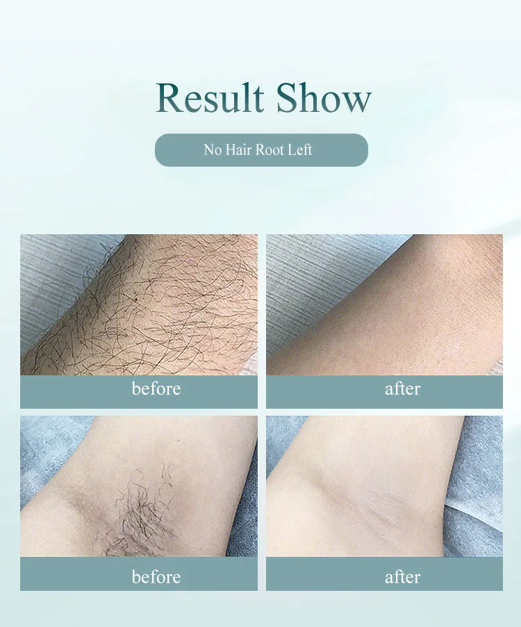 
Fast and Safe Painless Portable IPL Hair Removal Laser 