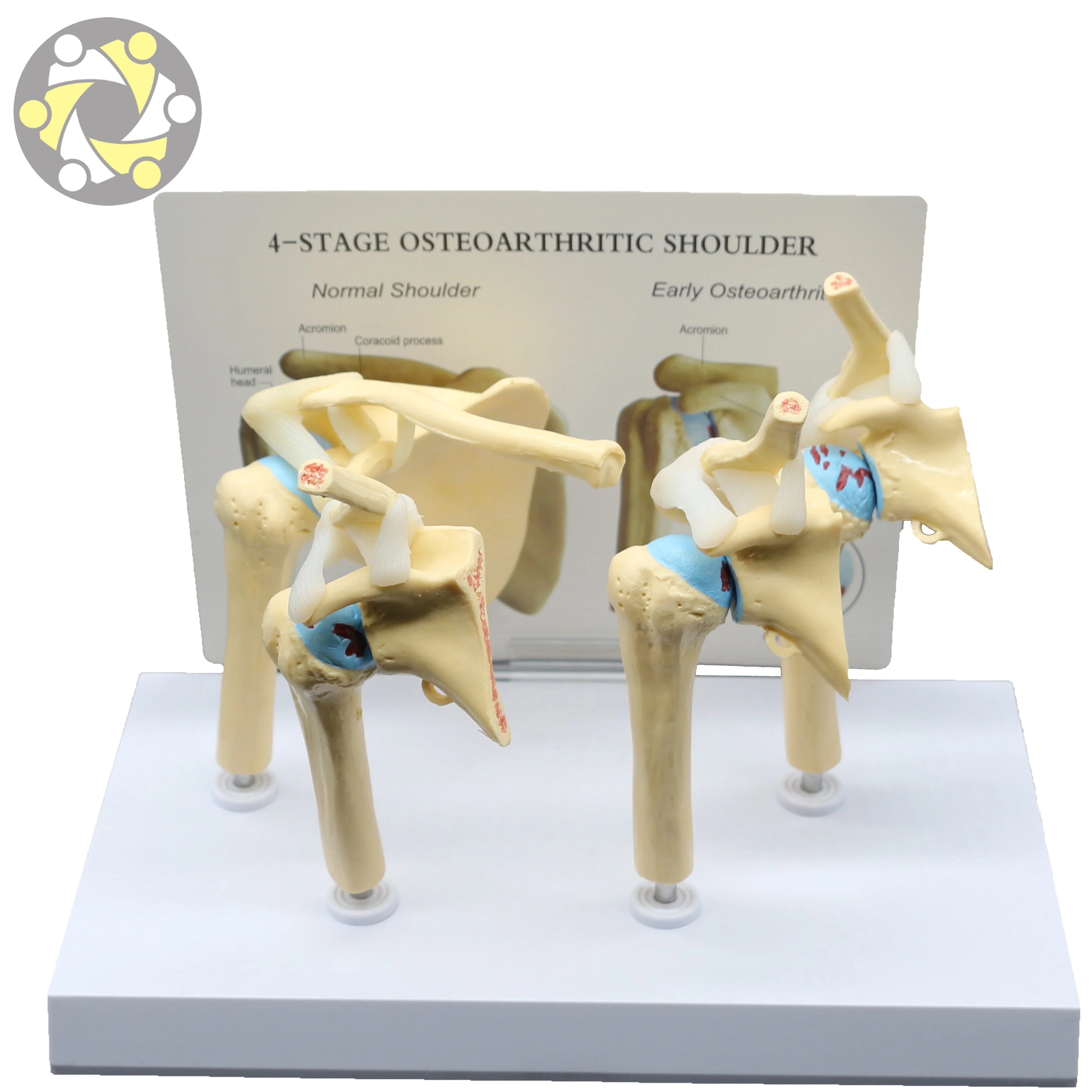 Medical Science Skeleton Model Human Diseased 4 Stage Osteoarthritic Shoulder Model for Teaching
