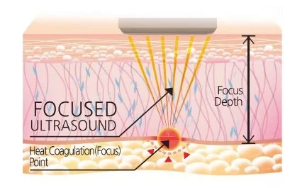 Powerful And Effective 7d V Max Lift Smas Machine 2022 / 2 Carteidges + 3 Vamx Cartridge Anti Aging Machine