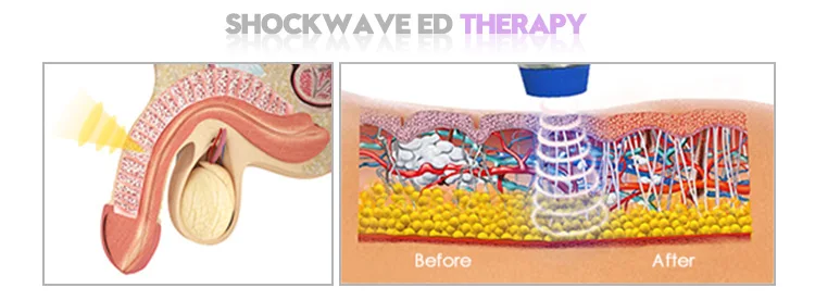 OEM ODM Shock Wave Therapy ED Extracorporeal Shockwave Therapy for Penis
