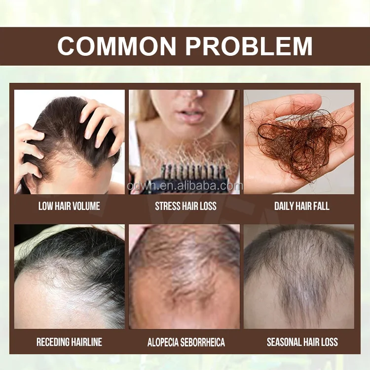 Women Men Anti Hair Loss Treatment Organic Ginger Hair Growth Oil For Hair Regrowth Spray