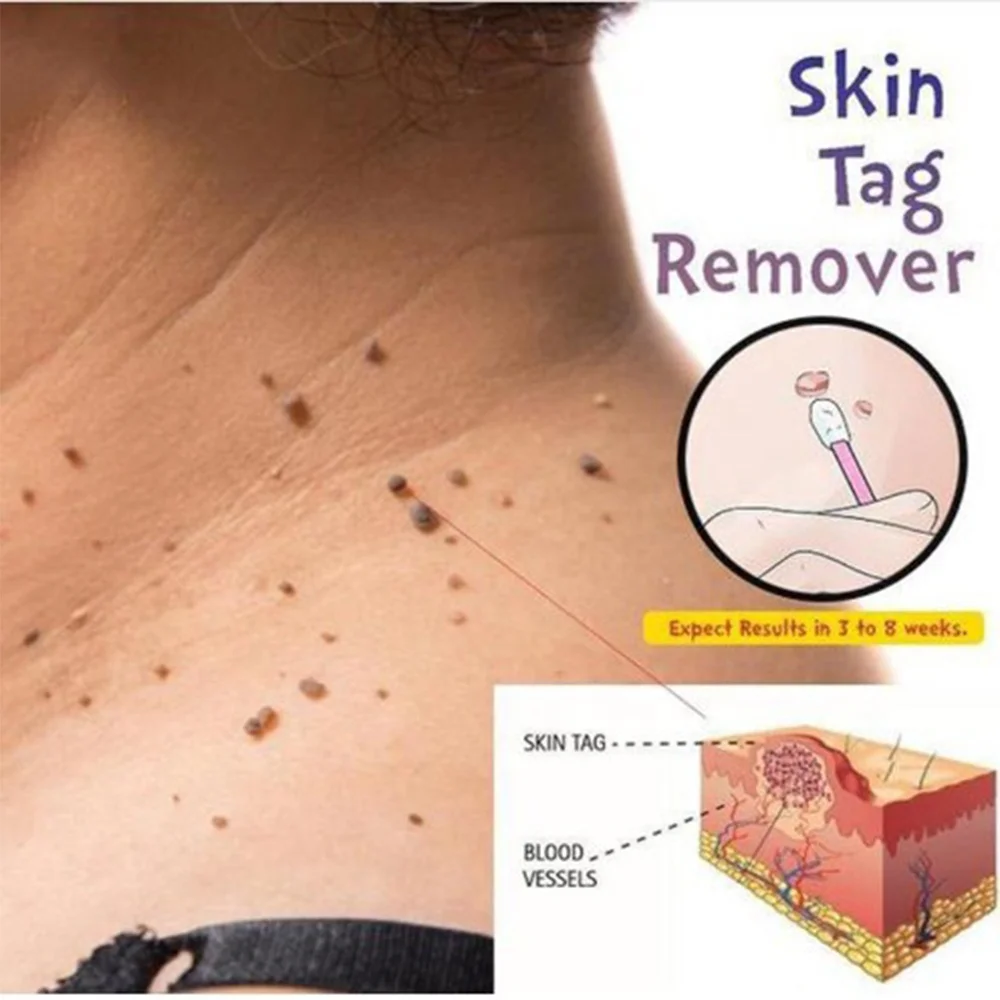 3031 10 мл Skin для удаления этикеток 12 часов Tu убить медицинский жидкость снятия бирки кожи моль половых органов борьбы с пигментацией кукурузы и черных