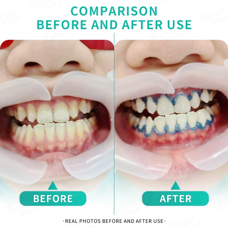 Advanced Popular portable teeth whitening lamp led light machine