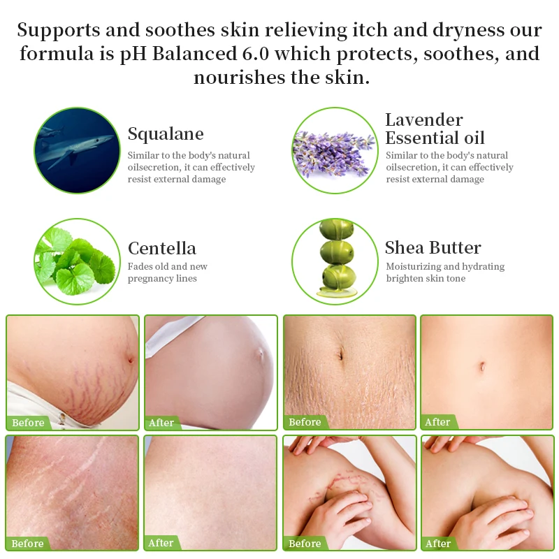 Stretchmark Remover Cream Natural Organic Body Scar Pregnancy Repair Body Anti Scar Removal Stretch Mark Cream