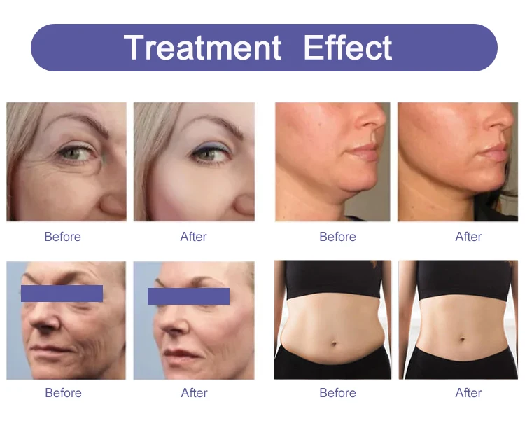 7d Korea Technology Best selling Portable Face Lifting Wrinkle Removal Hifu 7d Beauty Machine