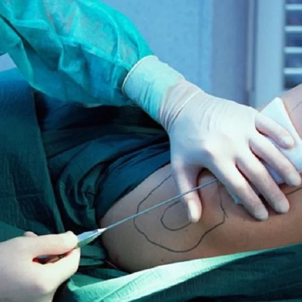 Laserconn slimming 980nm vaser liposuction machine 1470nm laser lipolysis fat removal lipo laser machine