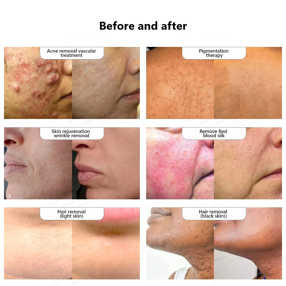 Two handles painless new DPL 808nm diode laser hair removal machine