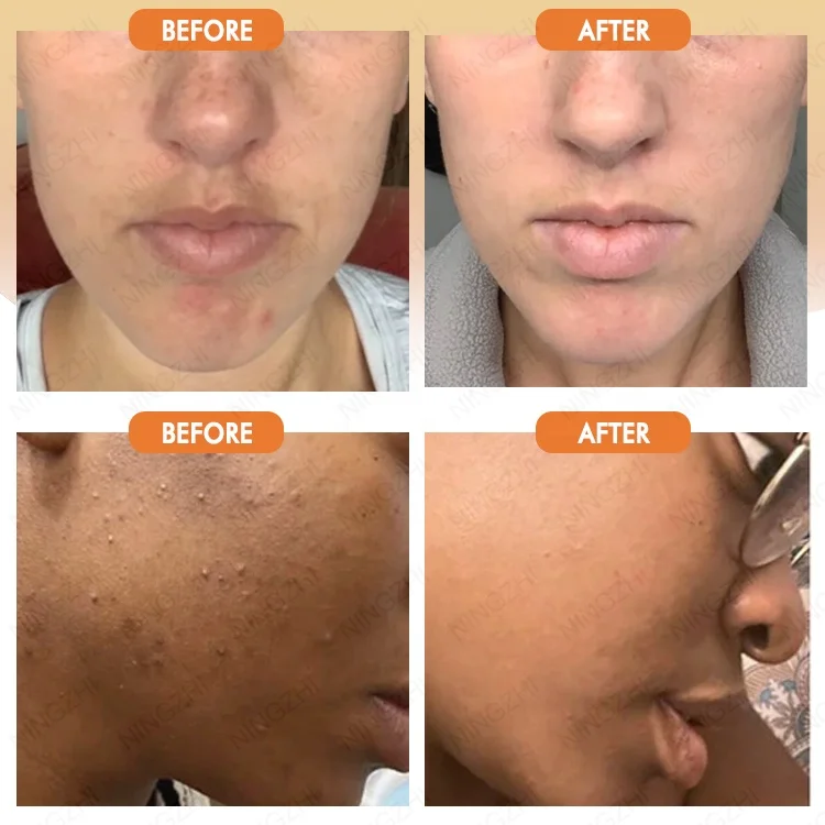 Custom logo hot selling even skin tone remove scar and stretch marks vitamin kojic acid turmeric pads