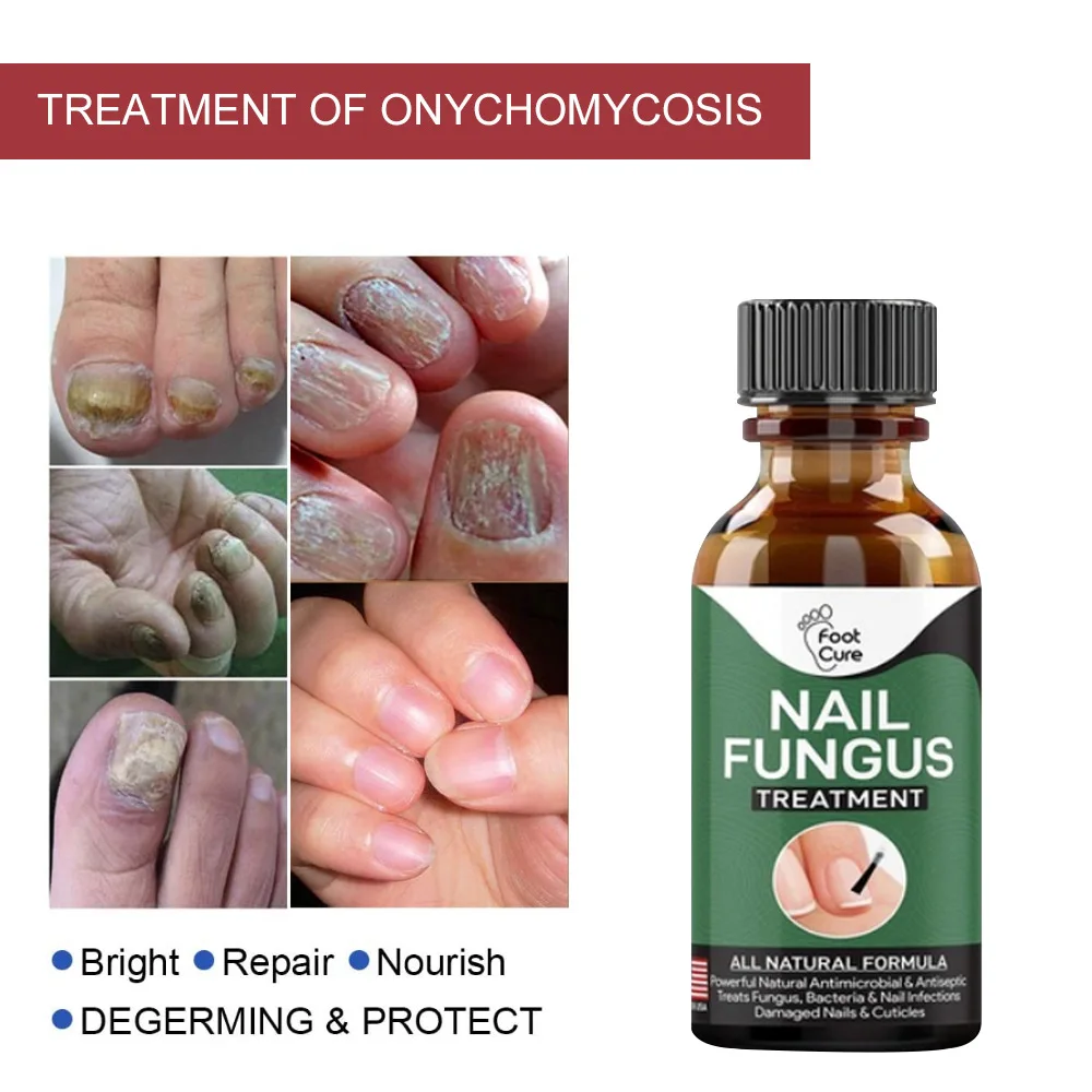 Nail Fungus treatment 10ml foot cure