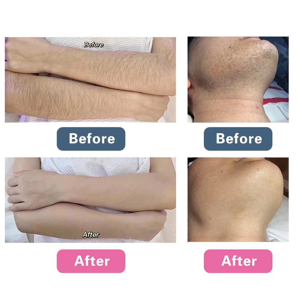 LOW price Permanent hair removal machine portable diode laser hair removal laser 755mm 808mm 1064mm