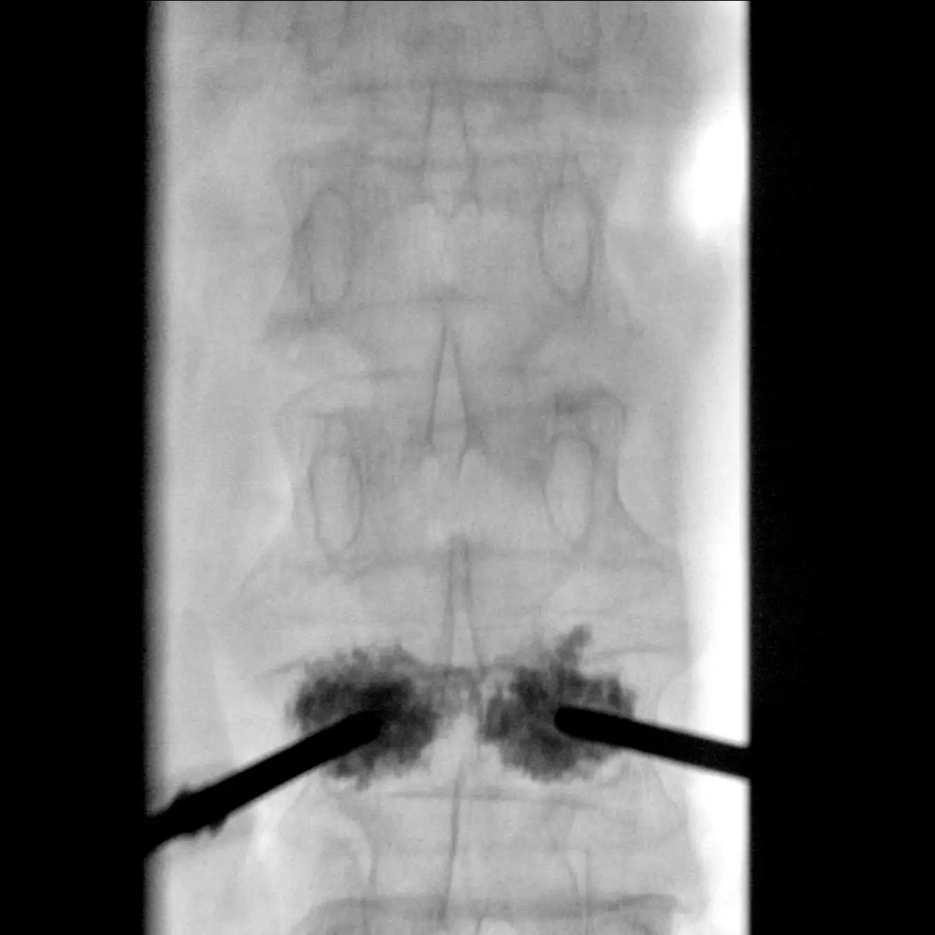 X-ray C-arm machine PLX118F what is c arm x ray machine