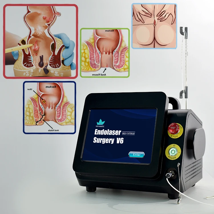 2025 new hemorrhoid surgery  laser  980nm 1470nm diode laser proctology hemorrhoids painless