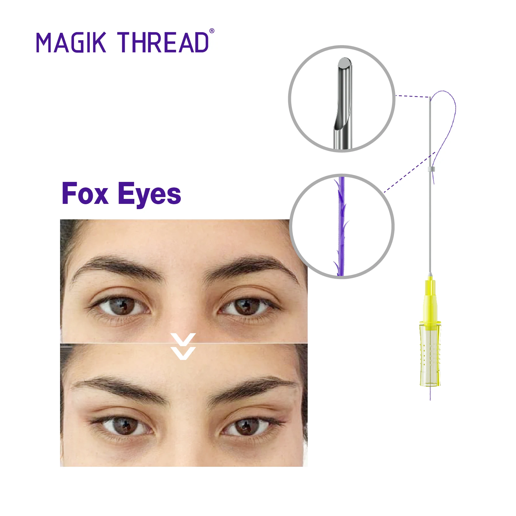 korea faden pdo thread fox eye COG 4d 21G 60mm 100mm korea lifting gold thread face lift pdo