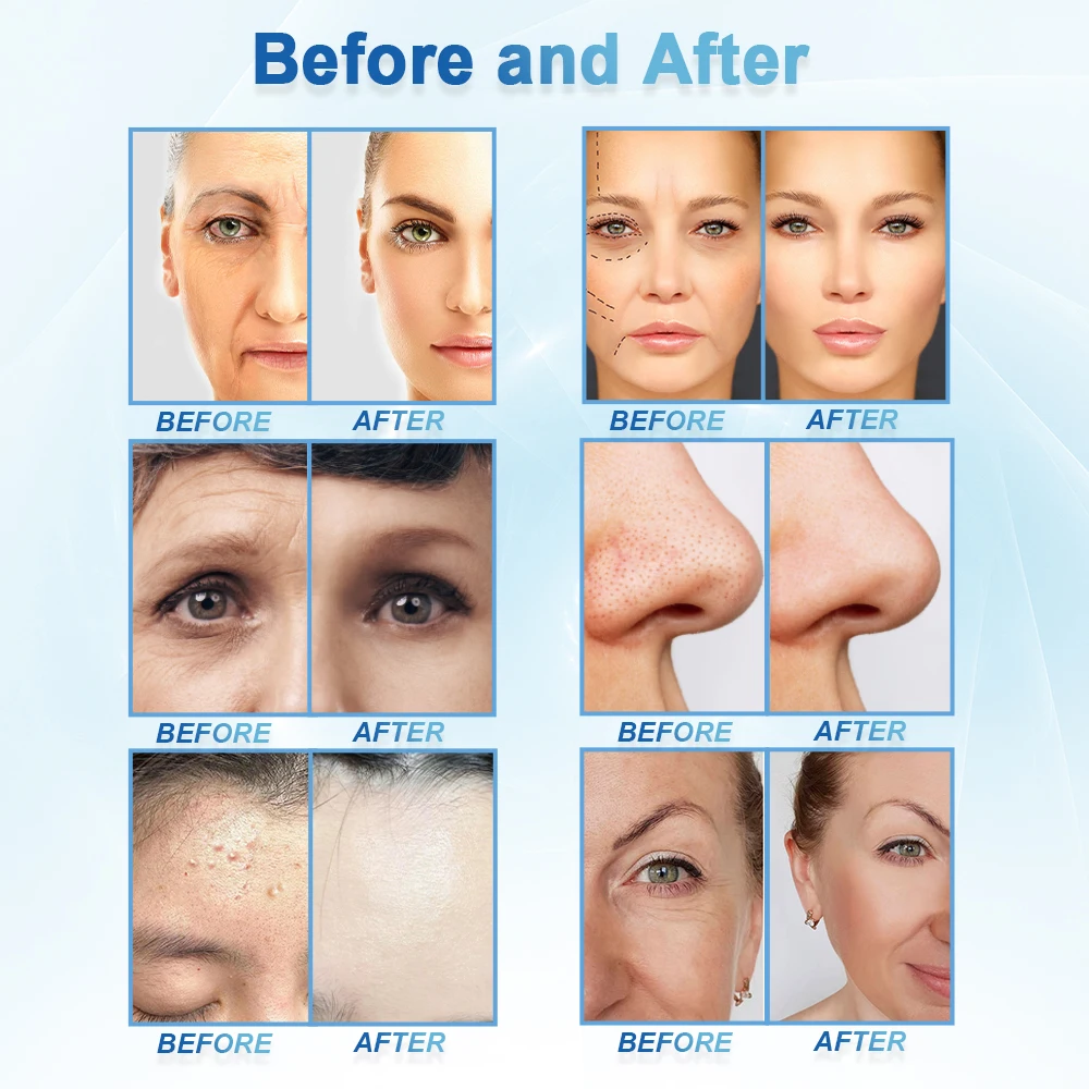 11 in 1 hydro dermabrasion vacuum suction blackhead shovel removal beauty hydra rf aqua peel skin scrubber facial machine